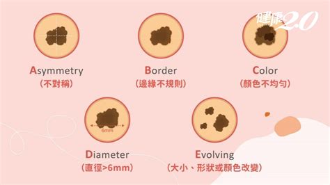 手長黑斑|別把癌當痣！5部位冒黑點恐是惡性黑色素瘤 台大醫師。